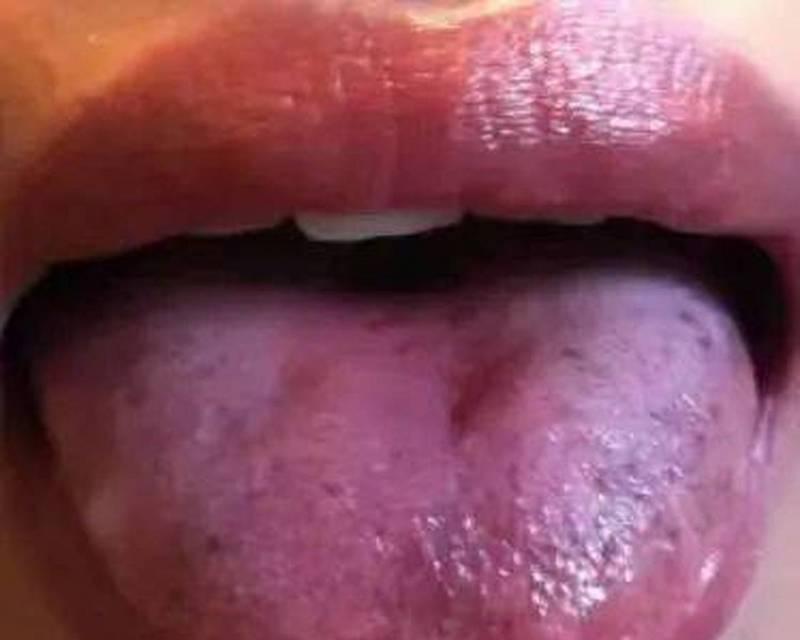 舌苔颜色与健康关系解析(图2)