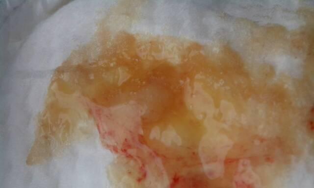 尿中出现血迹的原因及应对方法｜健康指南(图2)