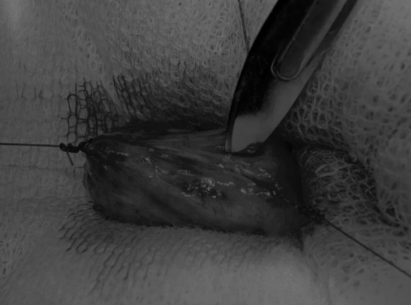 膀胱切开术操作流程解析｜附手术视频详解(图3)