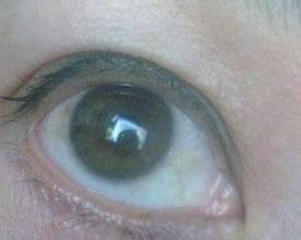 眼白混浊原因全攻略｜揭秘眼白变浑浊的根源与解决方法(图2)