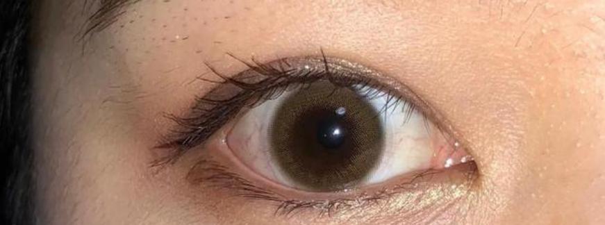 眼白混浊原因全攻略｜揭秘眼白变浑浊的根源与解决方法(图3)