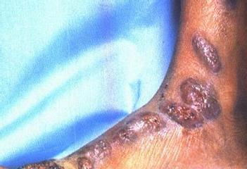 脓皮症成因与治疗全攻略｜预防方法及用药指导(图3)