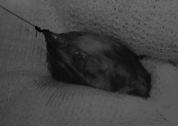 膀胱切开术全攻略：8图详解手术步骤及视频(图1)