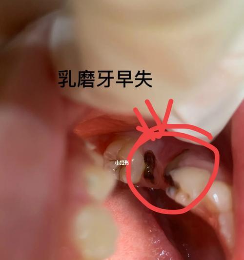 大牙的更替时机和保健方法（了解大牙更替的关键时期和正确的保健方法，保持口腔健康）(图3)