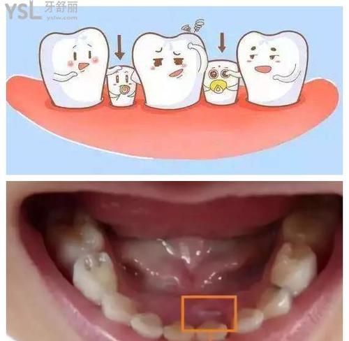 大牙的更替时机和保健方法（了解大牙更替的关键时期和正确的保健方法，保持口腔健康）(图1)