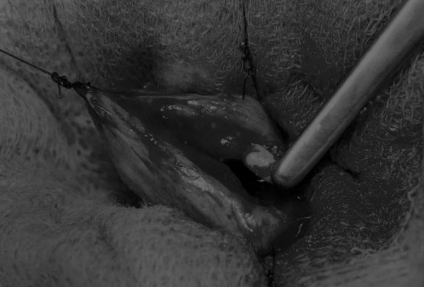 8张图解锁膀胱切开术：手术步骤详解与技巧全攻略(图4)