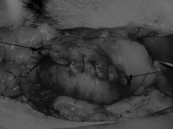 8张图解锁膀胱切开术技能｜附手术视频及操作全攻略(图8)