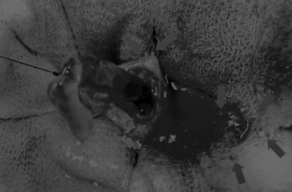 8张图解锁膀胱切开术技能｜附手术视频及操作全攻略(图5)