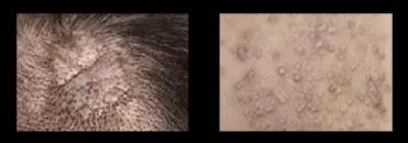 皮肤病为何治愈困难？（探究皮肤病难以治愈的原因及解决方法）(图1)